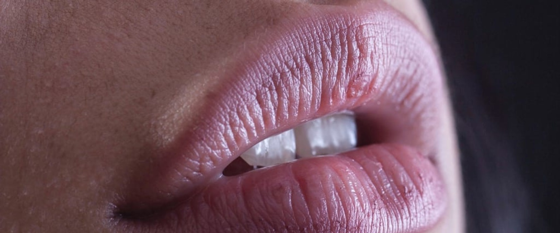What Are the Consequences of Filler Migration?