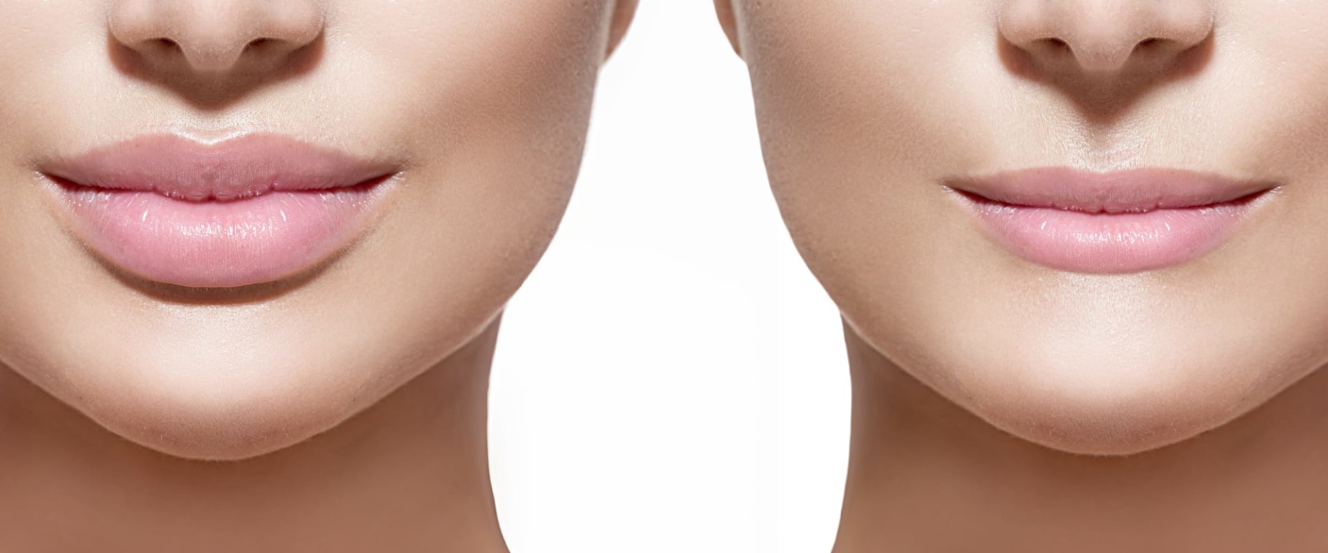 How Long Do Fillers Last? An Expert's Guide