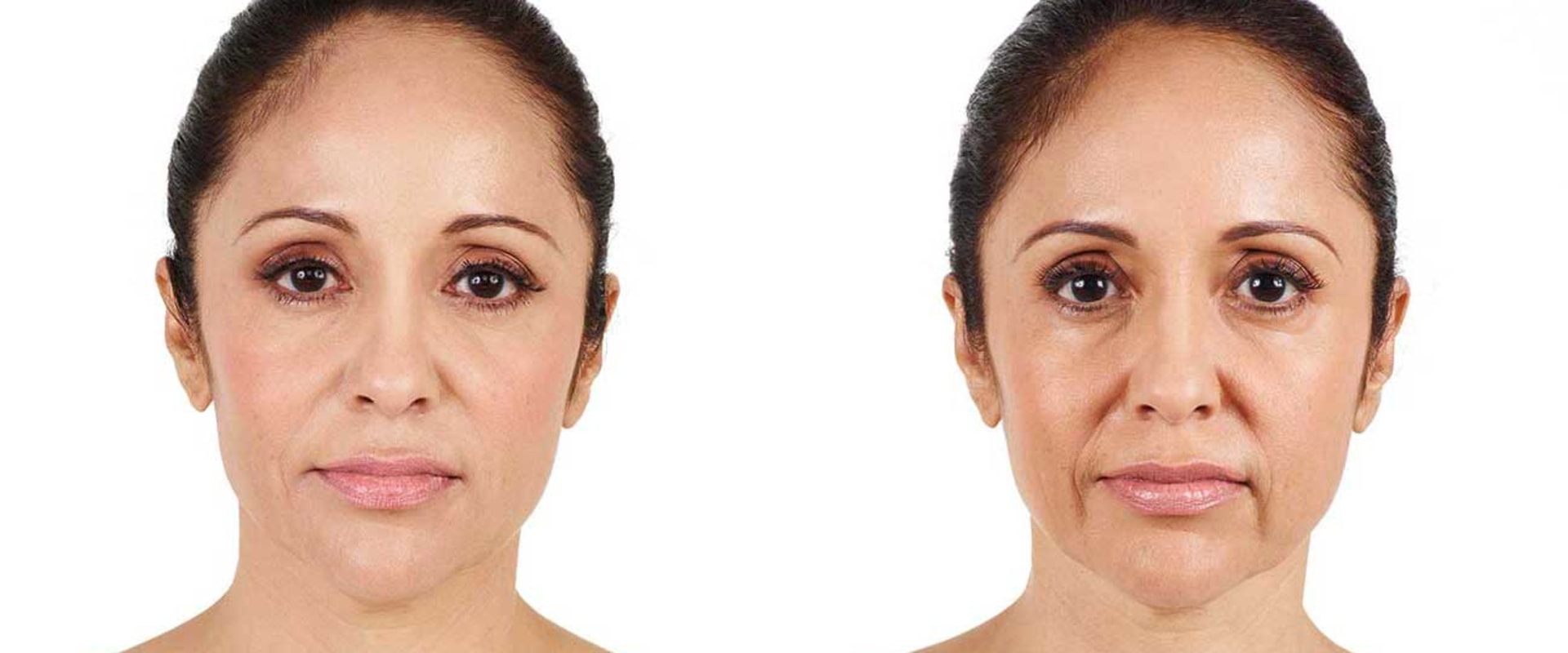 What is juvederm used for on the face?