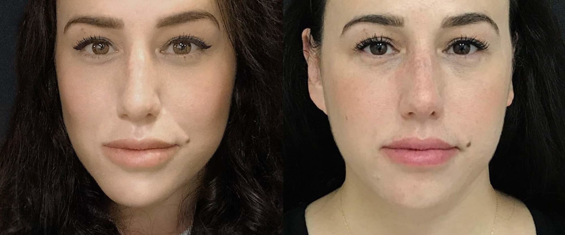 Does Juvederm Get Better Over Time?