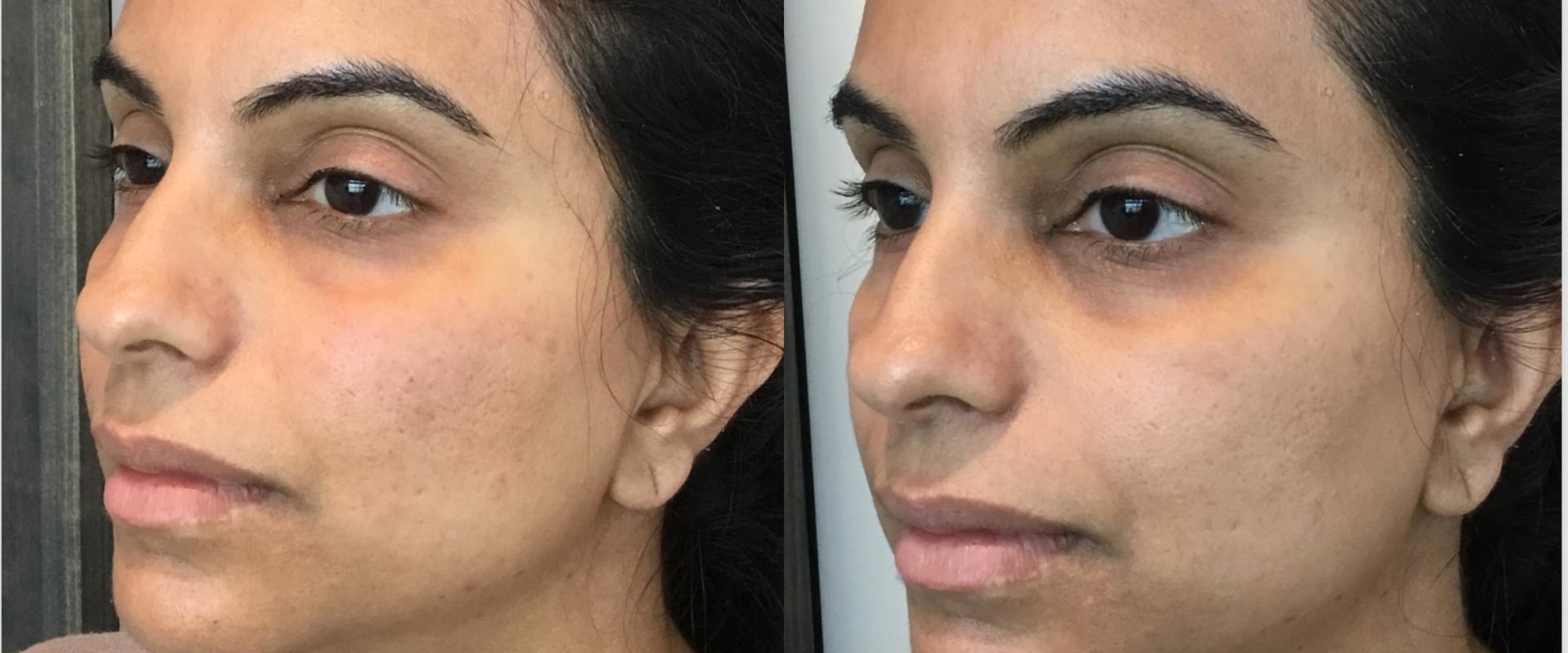 Are the effects of filler immediate?