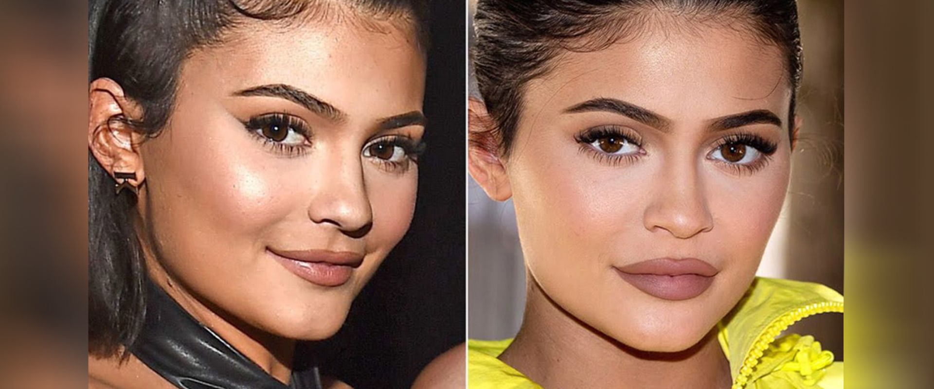 Can Fillers Be Completely Dissolved?