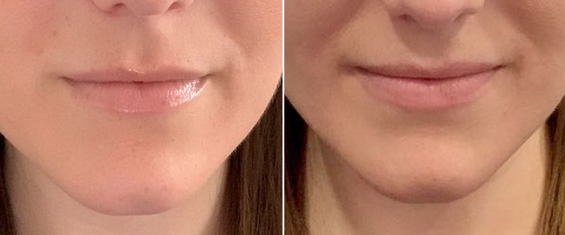 How Long Does Juvederm in Nasolabial Folds Last?