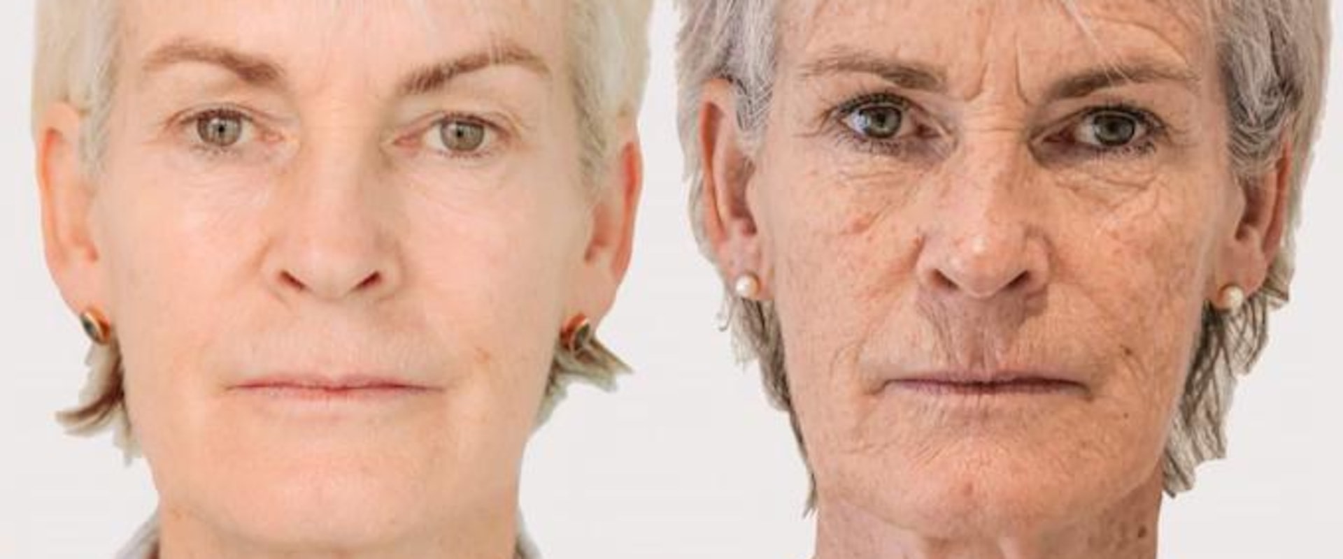 The Best Treatment for Sagging Jowls