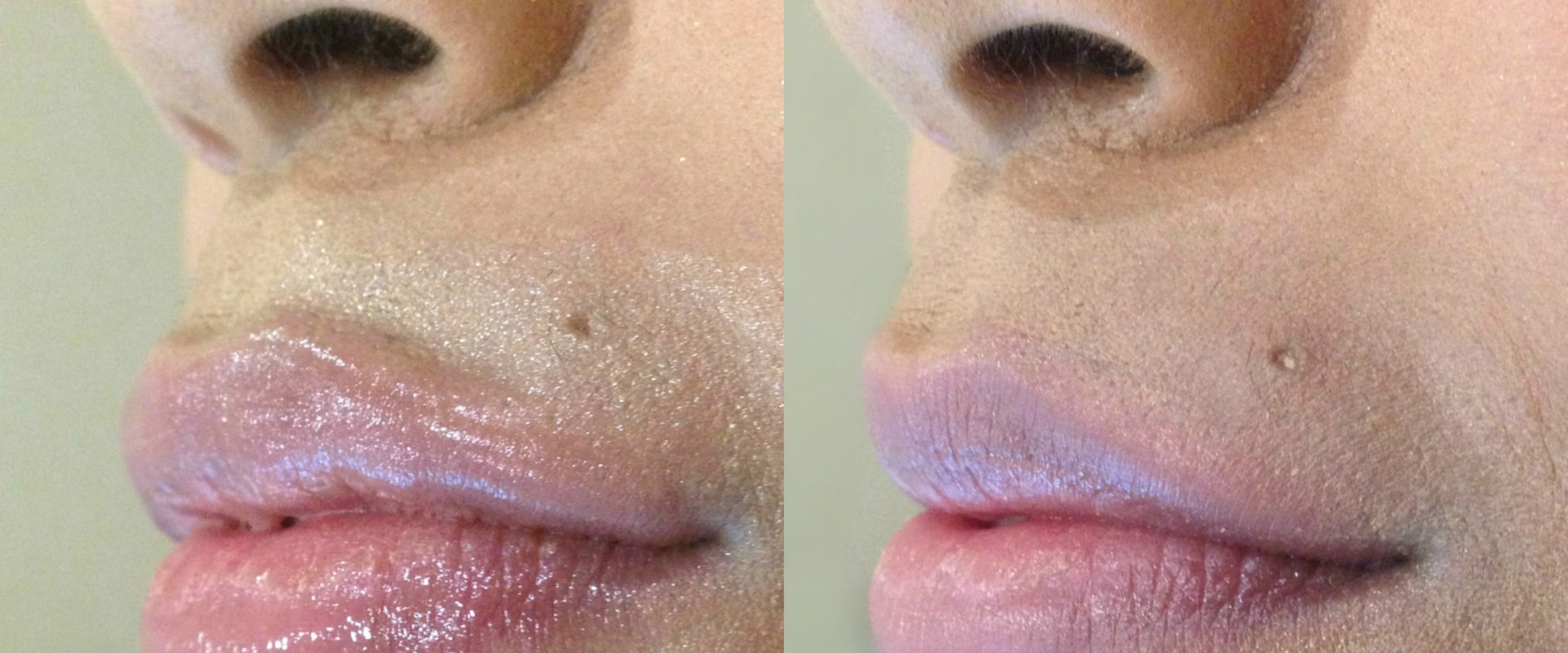 How Much Does Half a Syringe of Juvederm Cost?