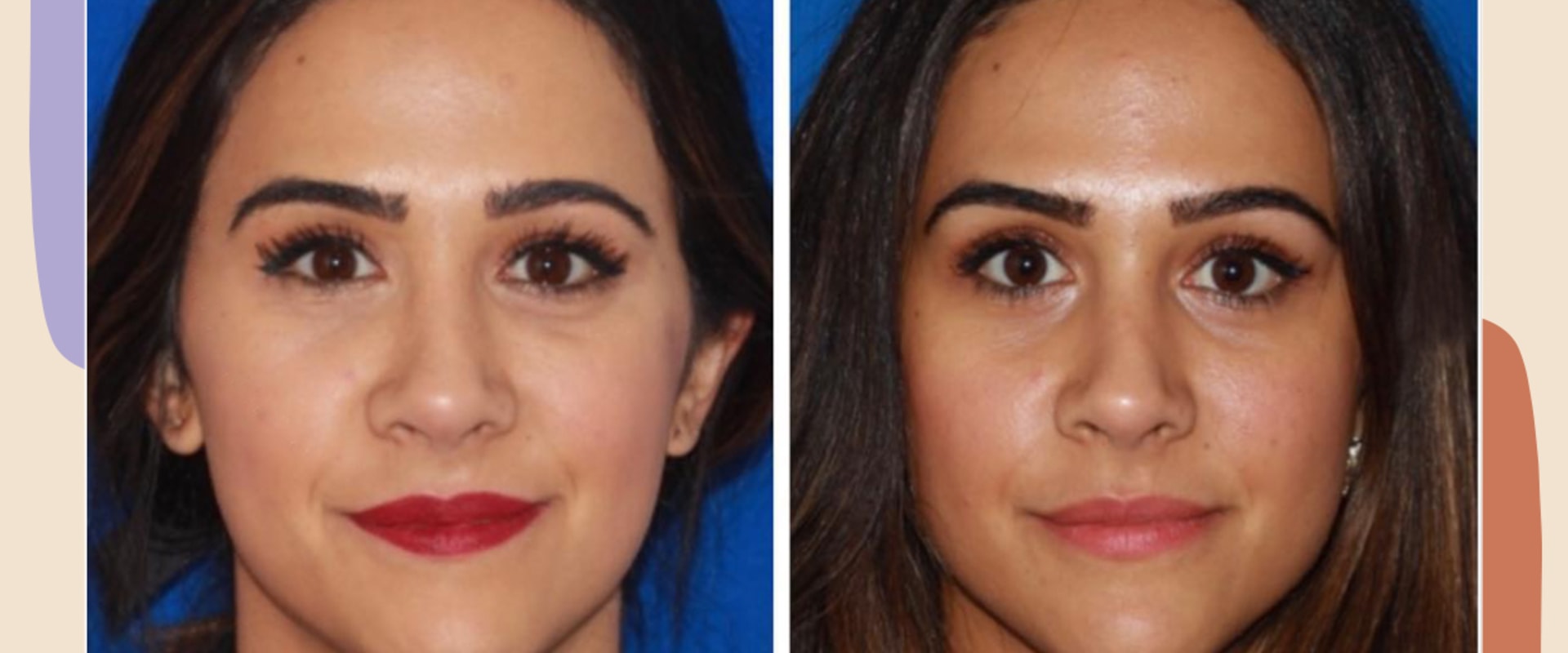 What Juvederm Filler is Used for Under Eyes? - An Expert's Perspective