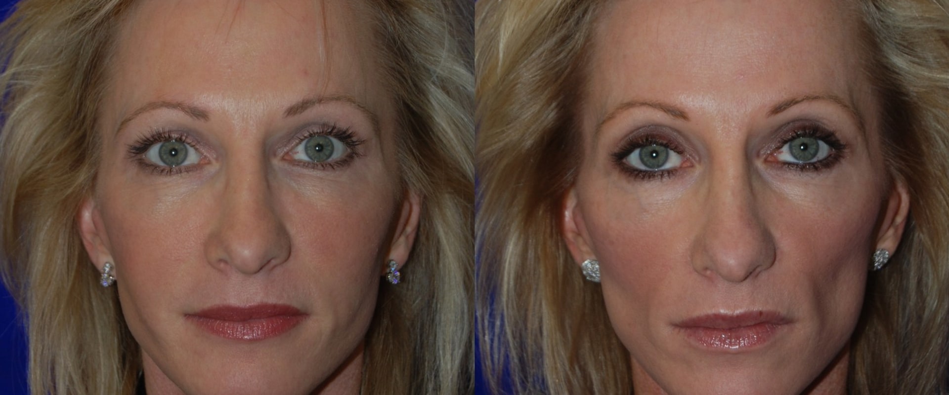 What to Expect from Juvederm Results