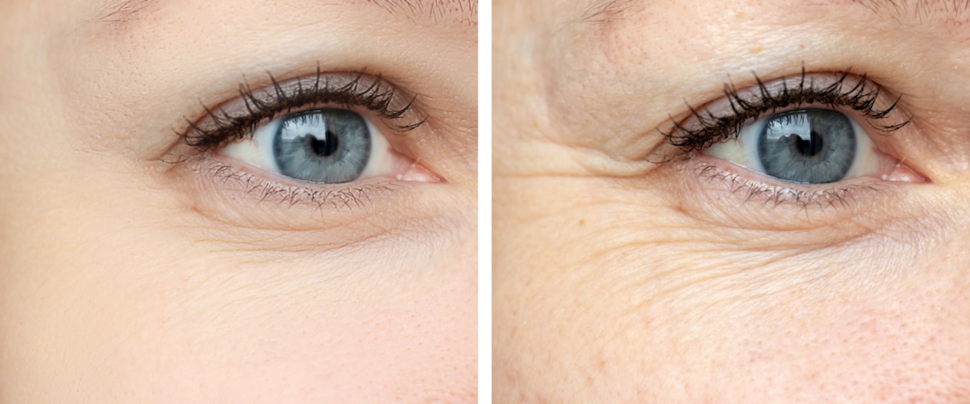 Is Juvederm Better Than Botox?