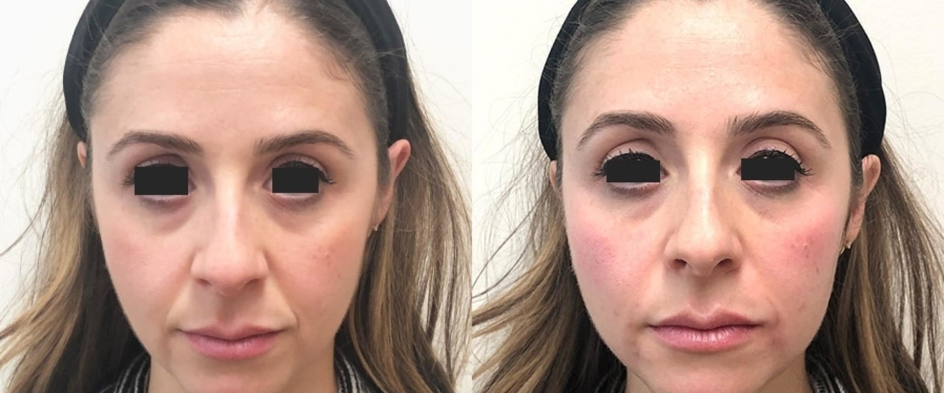 Do you see filler results right away?