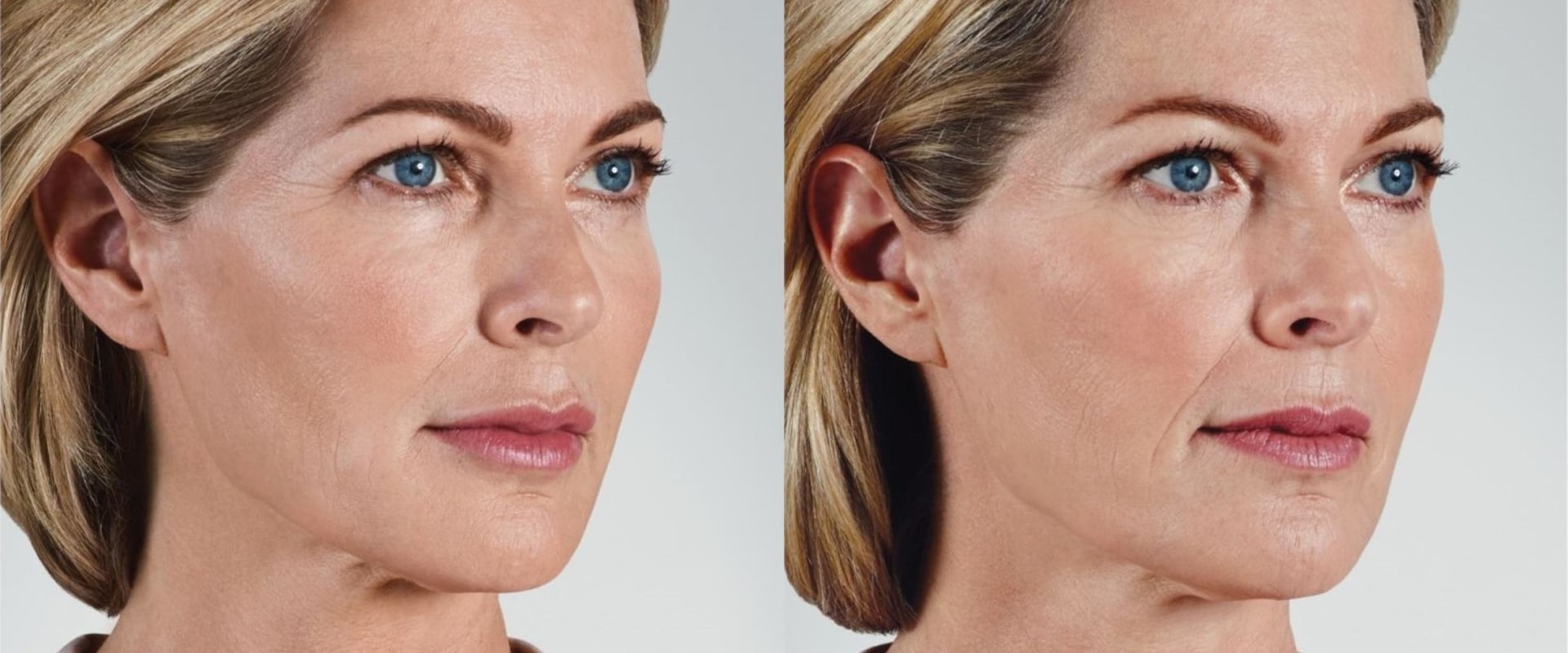 What Areas Can Juvederm Treat? A Comprehensive Guide