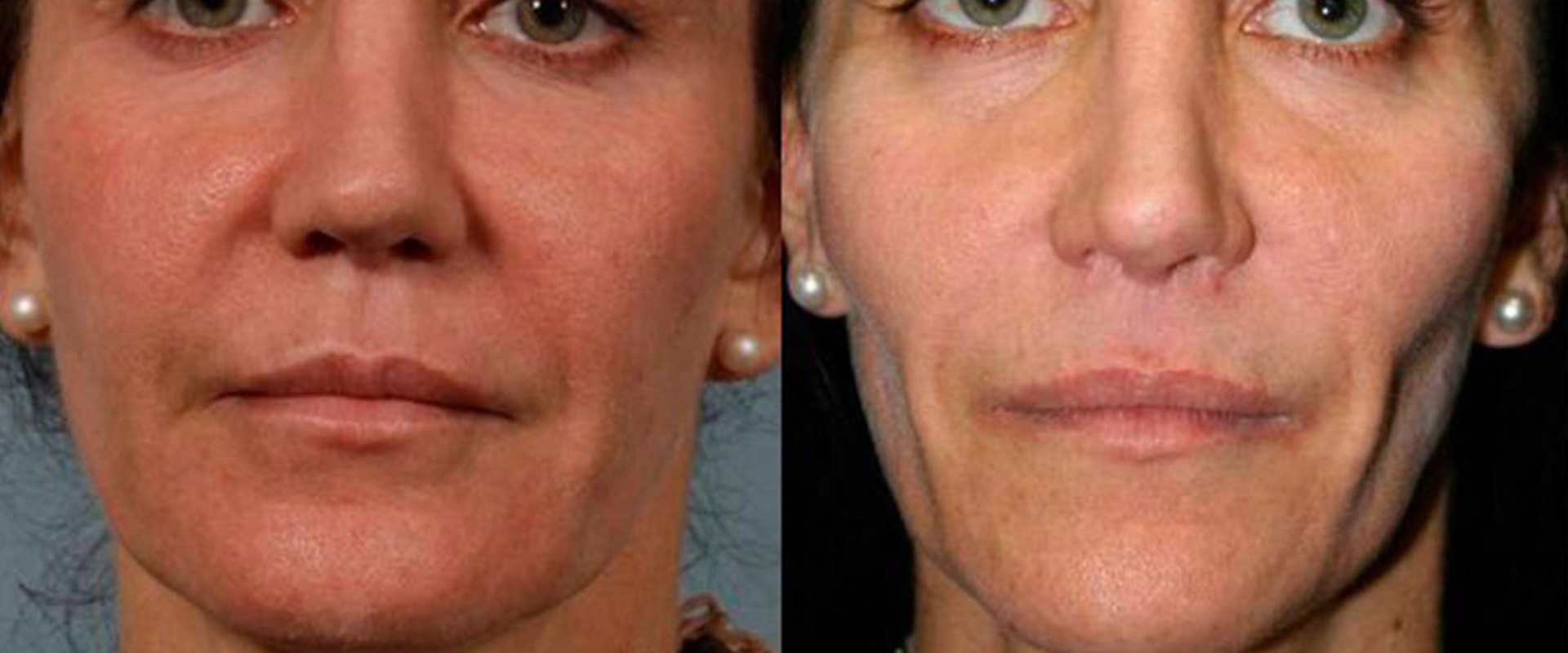 How long does it take to look normal after fillers?