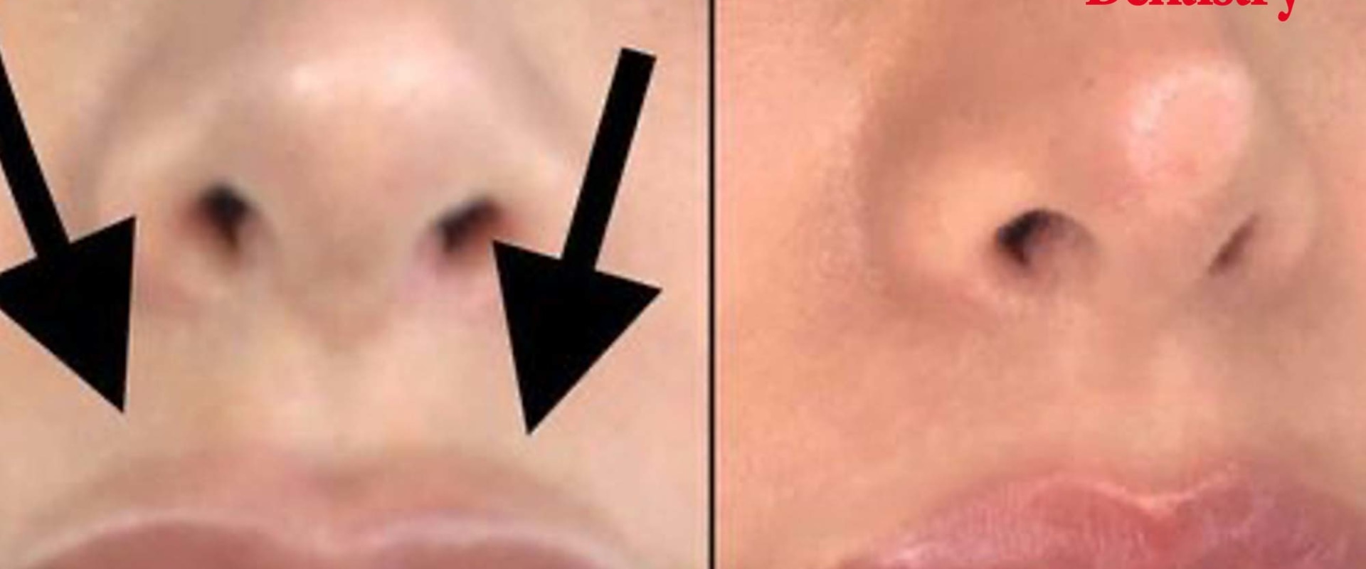How long after filler can you dissolve it?