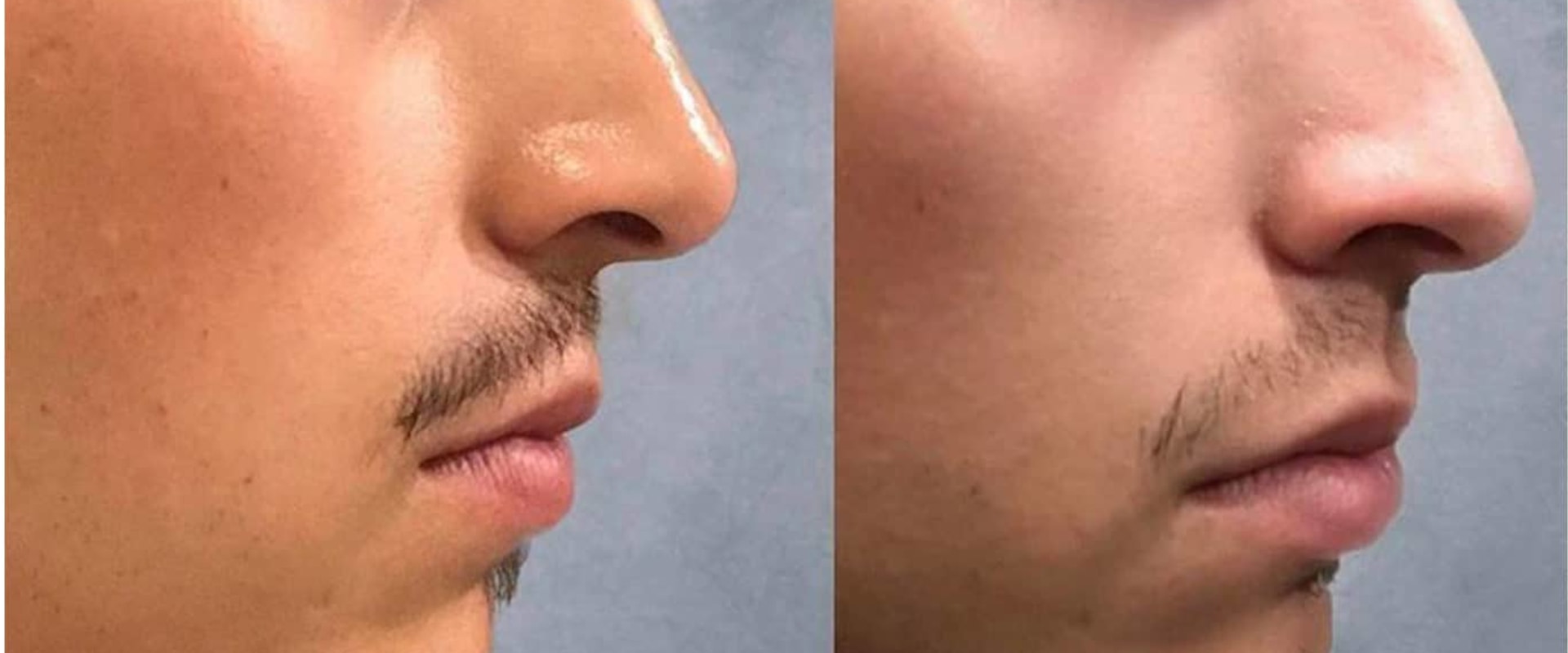 How Long Do Facial Fillers Last?