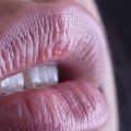 What Are the Consequences of Filler Migration?