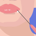 Juvederm Injections: Where Else Can You Get Them?