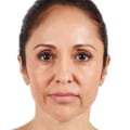 What is juvederm used for on the face?