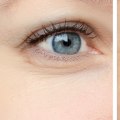 Which Treatment is Best for Forehead Wrinkles: Botox or Juvederm?