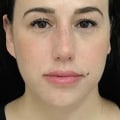 Does Juvederm Get Better Over Time?