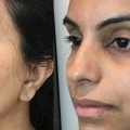 The Immediate Effects of Dermal Fillers