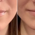 How Long Does Juvederm in Nasolabial Folds Last?
