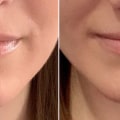 How long does juvederm in nasolabial folds last?