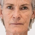What is best treatment for sagging jowls?