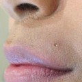How Much Does Half a Syringe of Juvederm Cost?