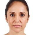 Which Filler is Better Than Juvederm: Restylane or Juvederm?