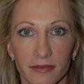 What to Expect from Juvederm Results