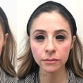 Do Dermal Fillers Show Results Right Away?