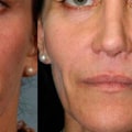 How Long Does it Take to Look Normal After Fillers?