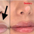 How Long Does It Take for Filler to Dissolve After Injection?