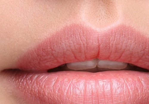 Which Dermal Filler Lasts the Longest?