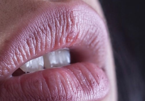 What Are the Consequences of Filler Migration?