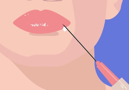 Juvederm Injections: Where Else Can You Get Them?