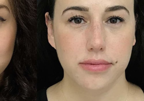 Does Juvederm Get Better Over Time?