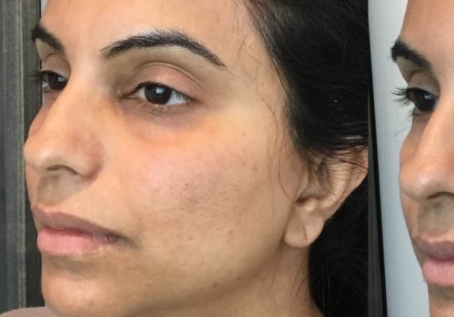 The Immediate Effects of Dermal Fillers