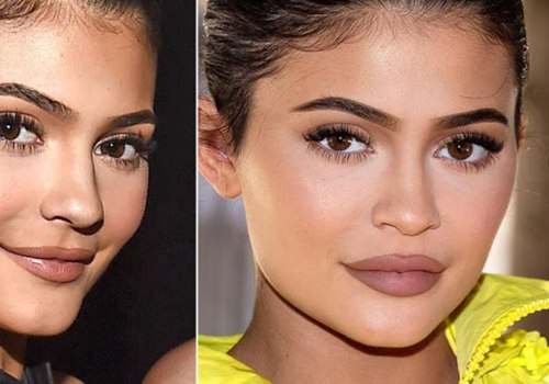 Can Fillers Be Completely Dissolved?