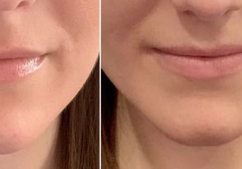 How Long Does Juvederm in Nasolabial Folds Last?