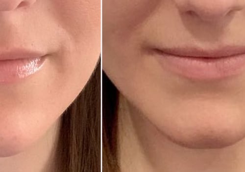 How long does juvederm in nasolabial folds last?