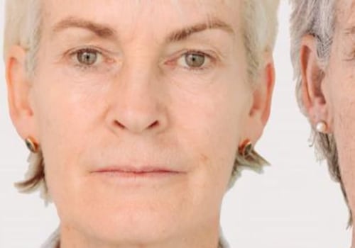 What is best treatment for sagging jowls?