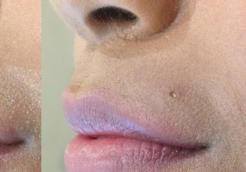 How Long Does Juvederm Ultra Plus Last in Nasolabial Folds?