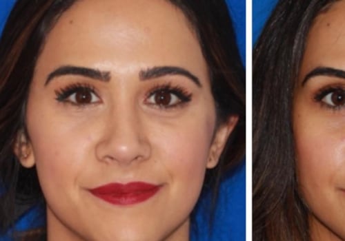 What Juvederm Filler is Used for Under Eyes? - An Expert's Perspective