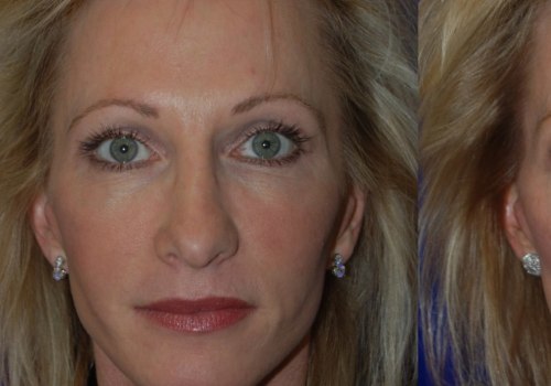 Are juvederm results immediate?