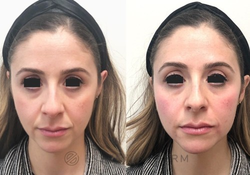 Do Dermal Fillers Show Results Right Away?