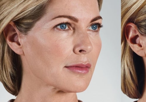 What Areas Can Juvederm Treat? A Comprehensive Guide