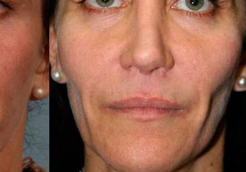 How Long Does it Take to Look Normal After Fillers?