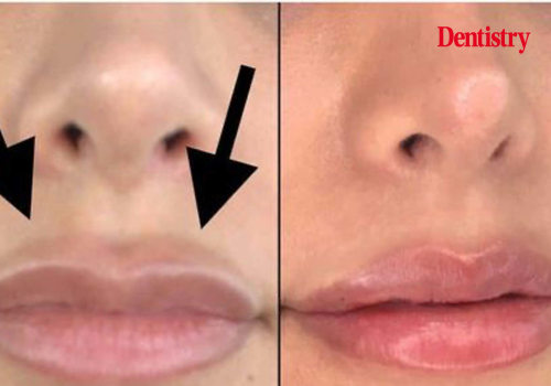 How Long Does It Take for Filler to Dissolve After Injection?