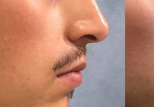 How Long Do Facial Fillers Last?